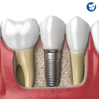 Single dental implant