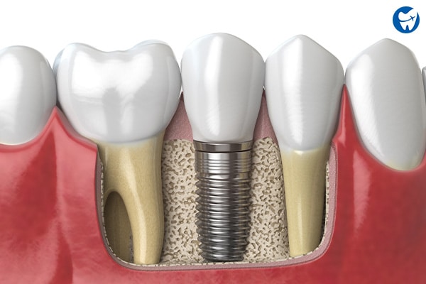 Single Dental Implant