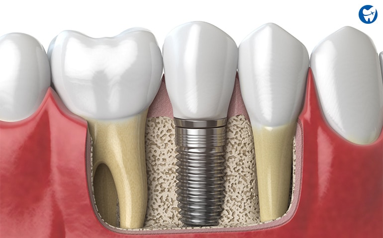 Dental implant in Antalya