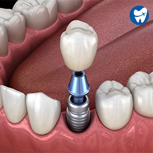 implante dental unico en puerto rico