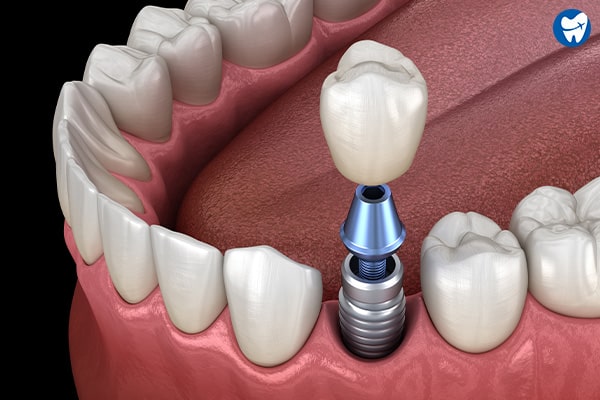 Dental restoration | Dental implants in Cartagena