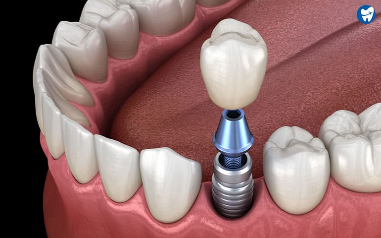 Single Dental Implant | Croatia