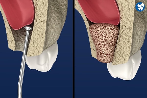 Sinus Lift, Bone Graft | Monterrey