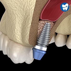 Sinus Lift Procedure