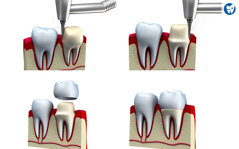 Tooth preparation for zirconia crown