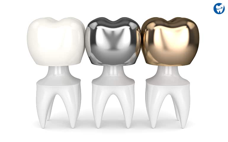 Types of dental crowns