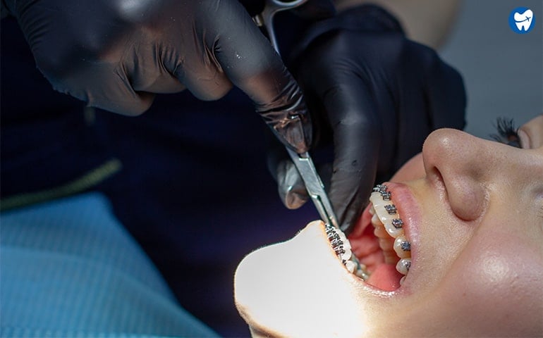 Orthodontic Treatment