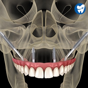 Zygomatic Dental implants