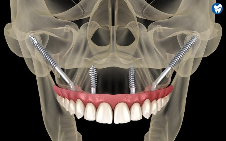 Zygomatic Implants in India