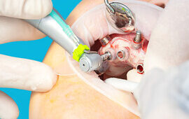 Guided dental surgery