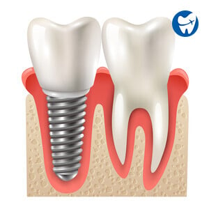 Dental Implant 