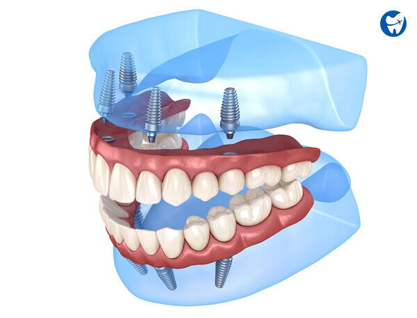 Implant-supported Dentures