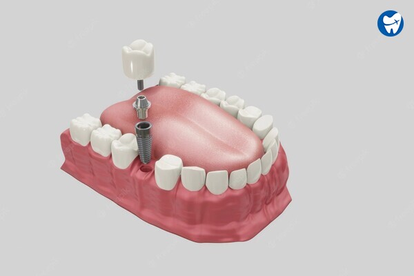 single Dental Implant