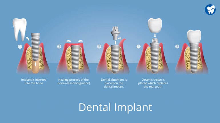 Dental implant process