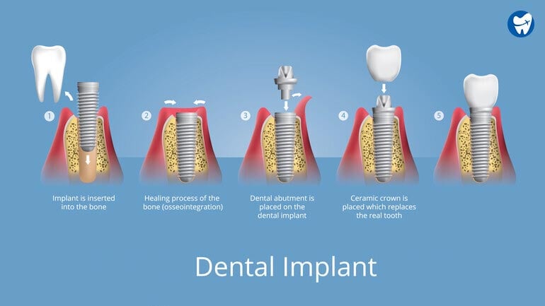 Dental Implant Procedure