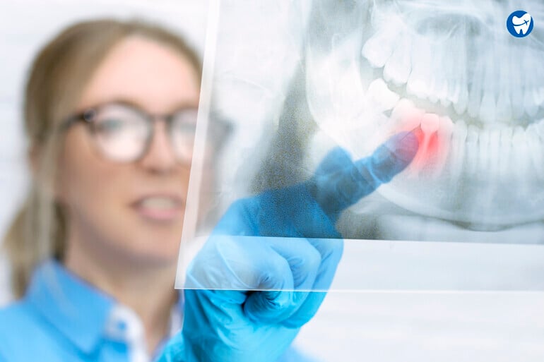 Full Mouth X-ray taken before extraction