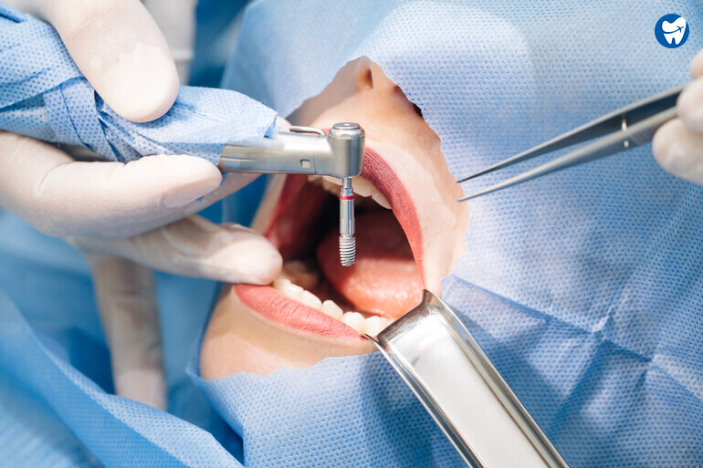 Dental Implant Surgery in Dubai