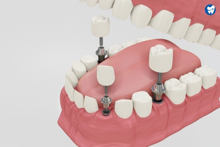 Multiple dental implants