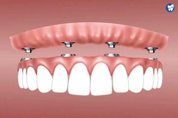 Overdenture