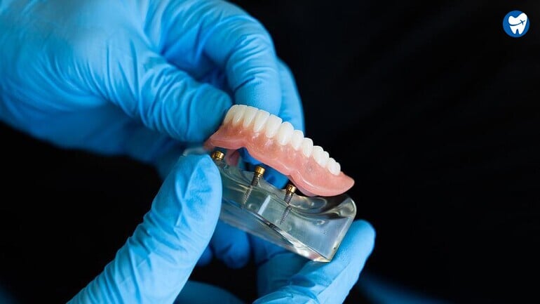 Overdenture