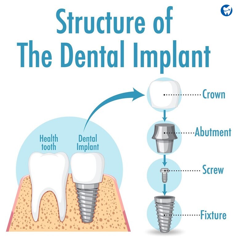 Dental Implant Structure: Crown, Abutment and Post