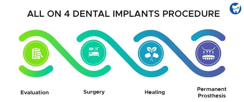 All on 4 Dental Implants Procedure