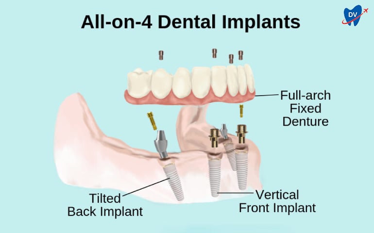 All on 4 Implants in Turkey