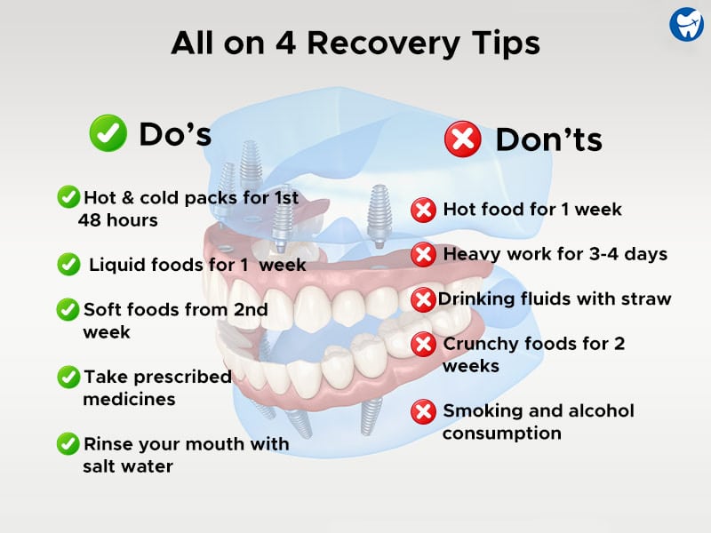 All-on-4 Dental Implants | Recovery Tips