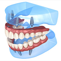 Todo en 4 implantes dentales