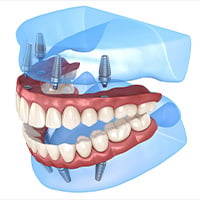 All on 4 dental implants