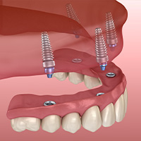 All on 4 dental implants in Jaco, Costa Rica