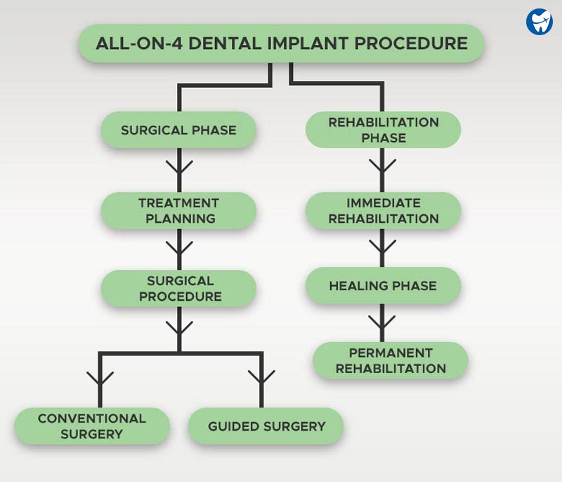 All on 4 Dental Implant Procedure | Flow Chart