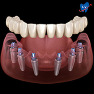 All on 6 dental Implants in Bangalore