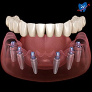 All on 6 dental Implants in Bangalore