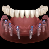 All on 6 Dental Implants