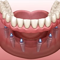 All on 6 dental implants