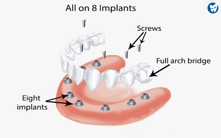 All on 8 dental implants abroad