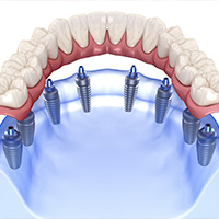 All on 8 dental implants in Nuevo Laredo
