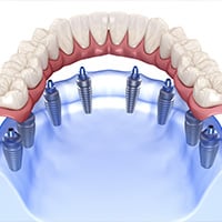 All on 8 dental implants in Nuevo Laredo