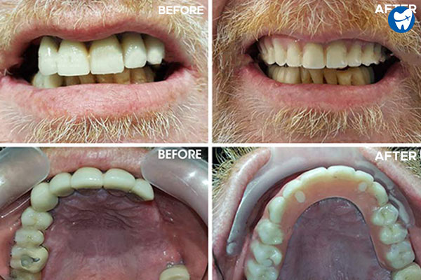 All on Four Upper Jaw – Before & After