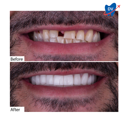 Before & After Dental Bridge in Mexico