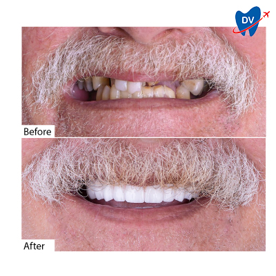 Before & After Dental Bridge in Mexico