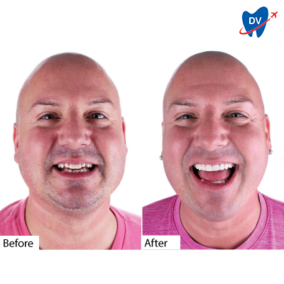 Before & After Dental Veneers | Los Algodones, Mexico