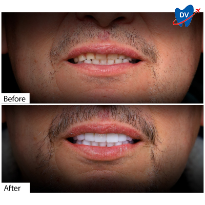 Before & After Dental Veneers | Los Algodones, Mexico