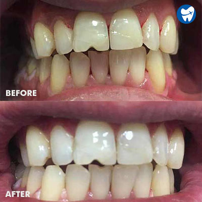 Before After Teeth Whitening in Hungary