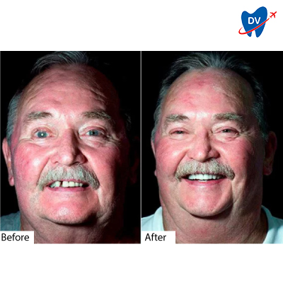 Dental Implants in Cancun, Mexico: Before & After 