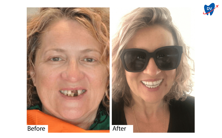 Before & After Dental Implants in Cancun, Mexico