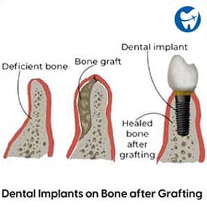 Bone Graft