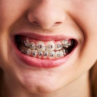 Dental braces in Guatemala
