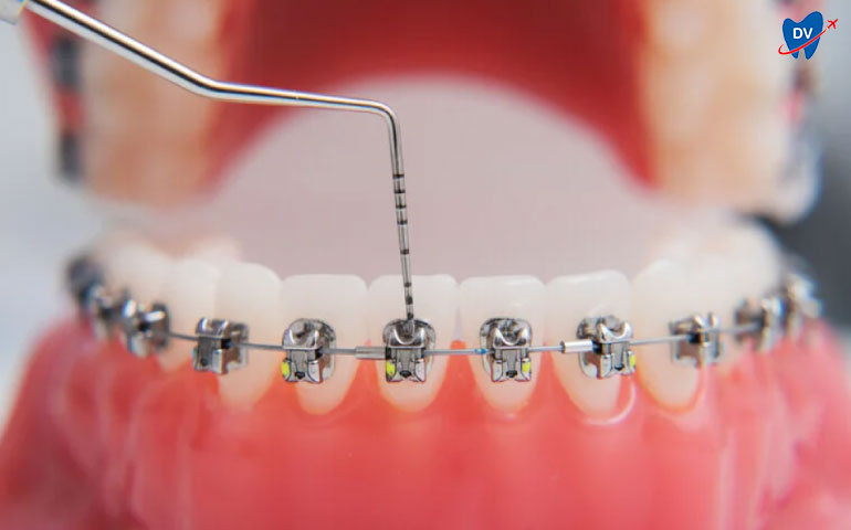 Cosmetic Dental Work in Algodones | Dental Braces